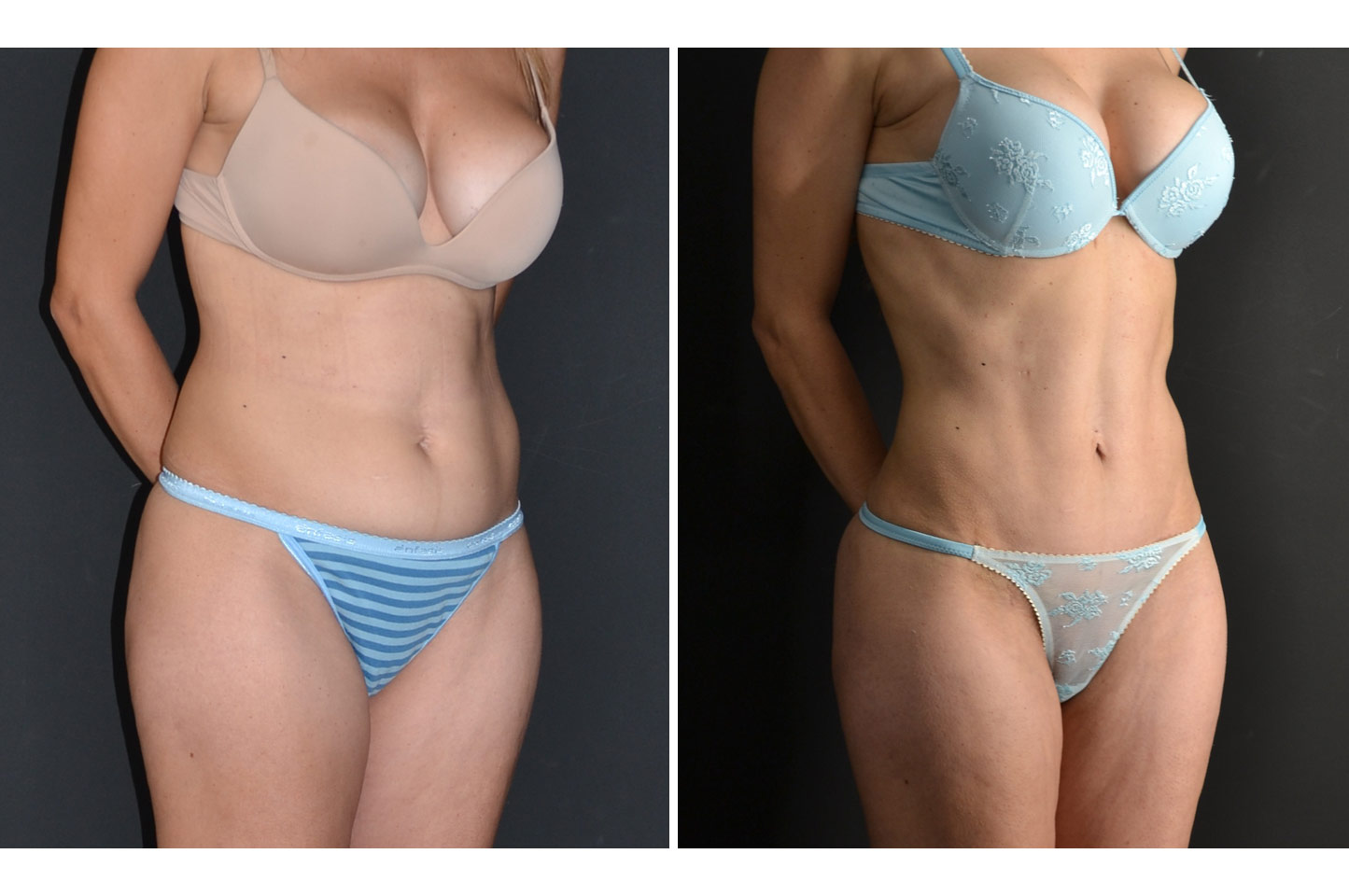 abdominoplasty-w-b2