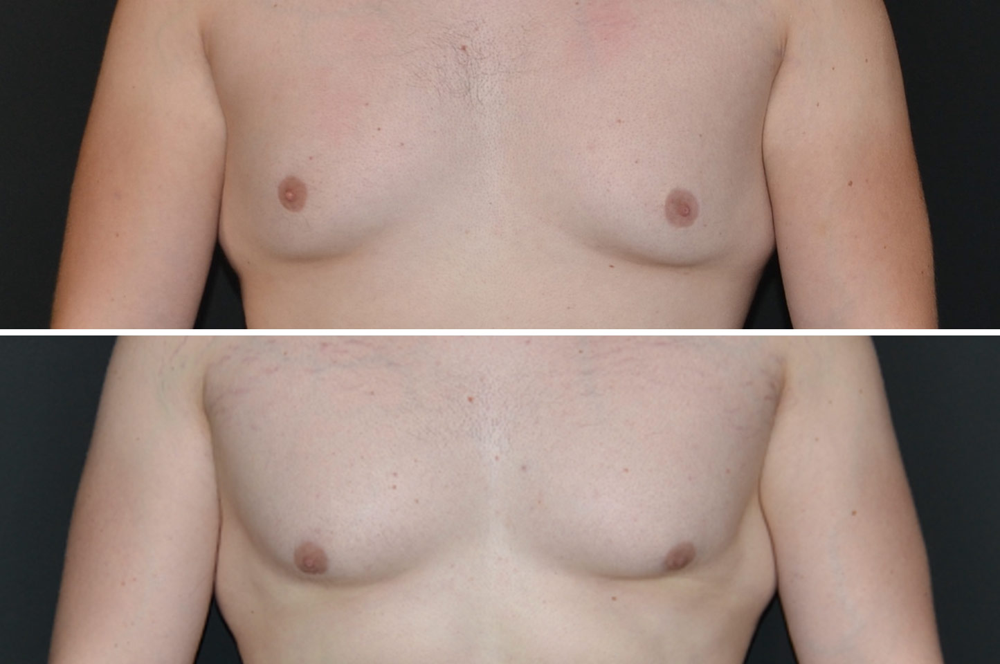 gynecomastia-a1