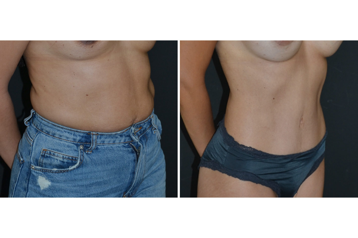 tummy-tuck-w-a1