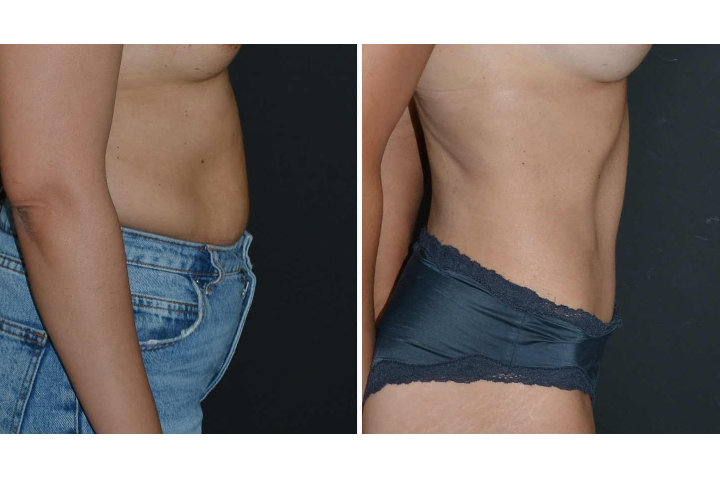 tummy-tuck-w-a2
