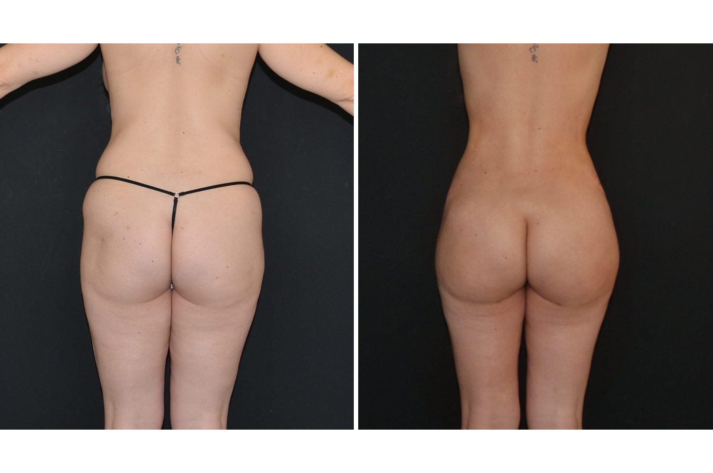 Brazilian Butt Lift bbl-woman-a2