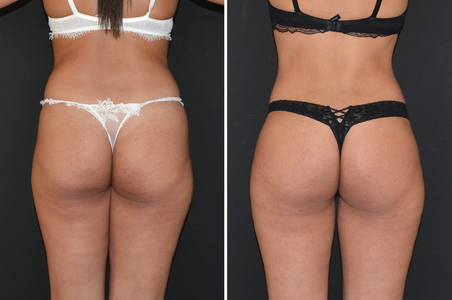 Brazilian Butt Lift bbl-woman-b1