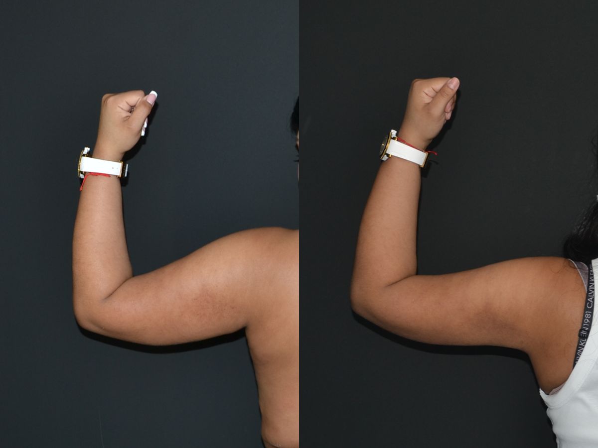 Blog Lipoescultura brazos1