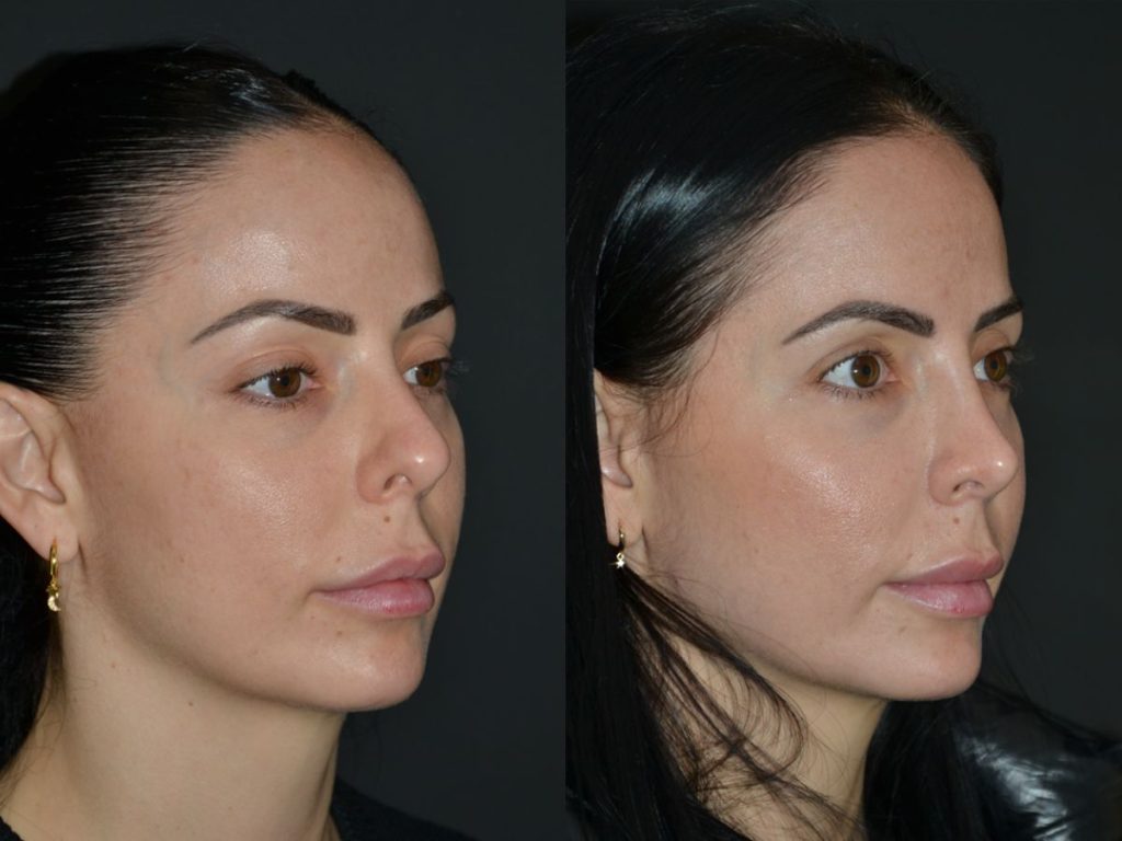 Post-Rhinoplasty care: Key tips and advice for a successful recovery Postoperatorio rinoplastia