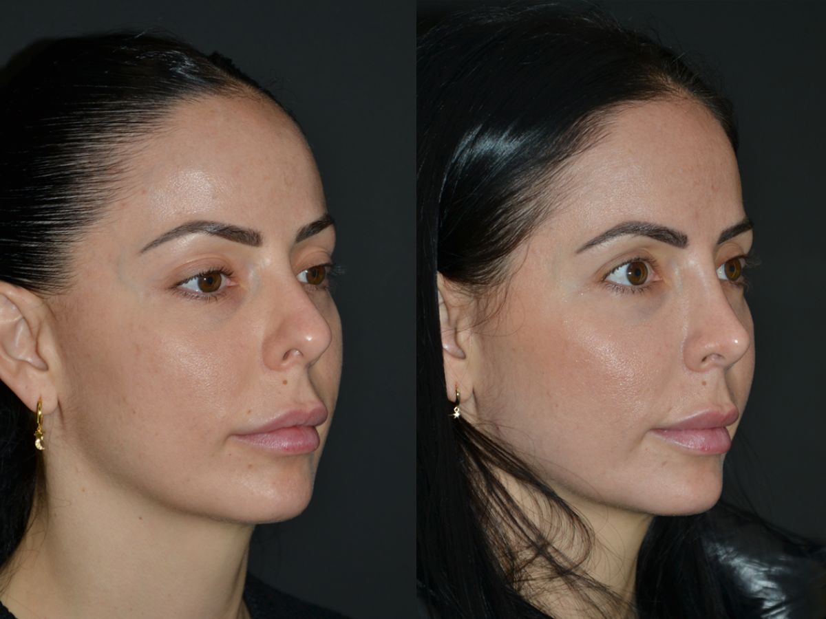 Blog Postoperatorio rinoplastia