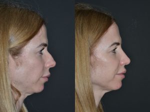 Postoperatorio rinoplastia1