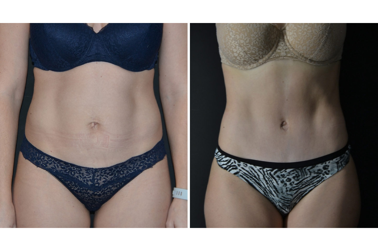gallery-abdominoplasty-a1