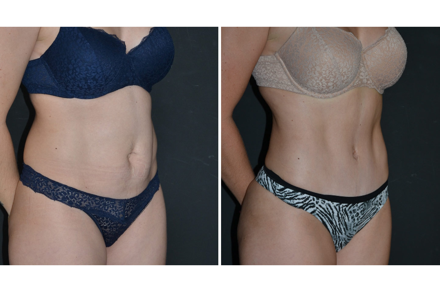 gallery-abdominoplasty-a2