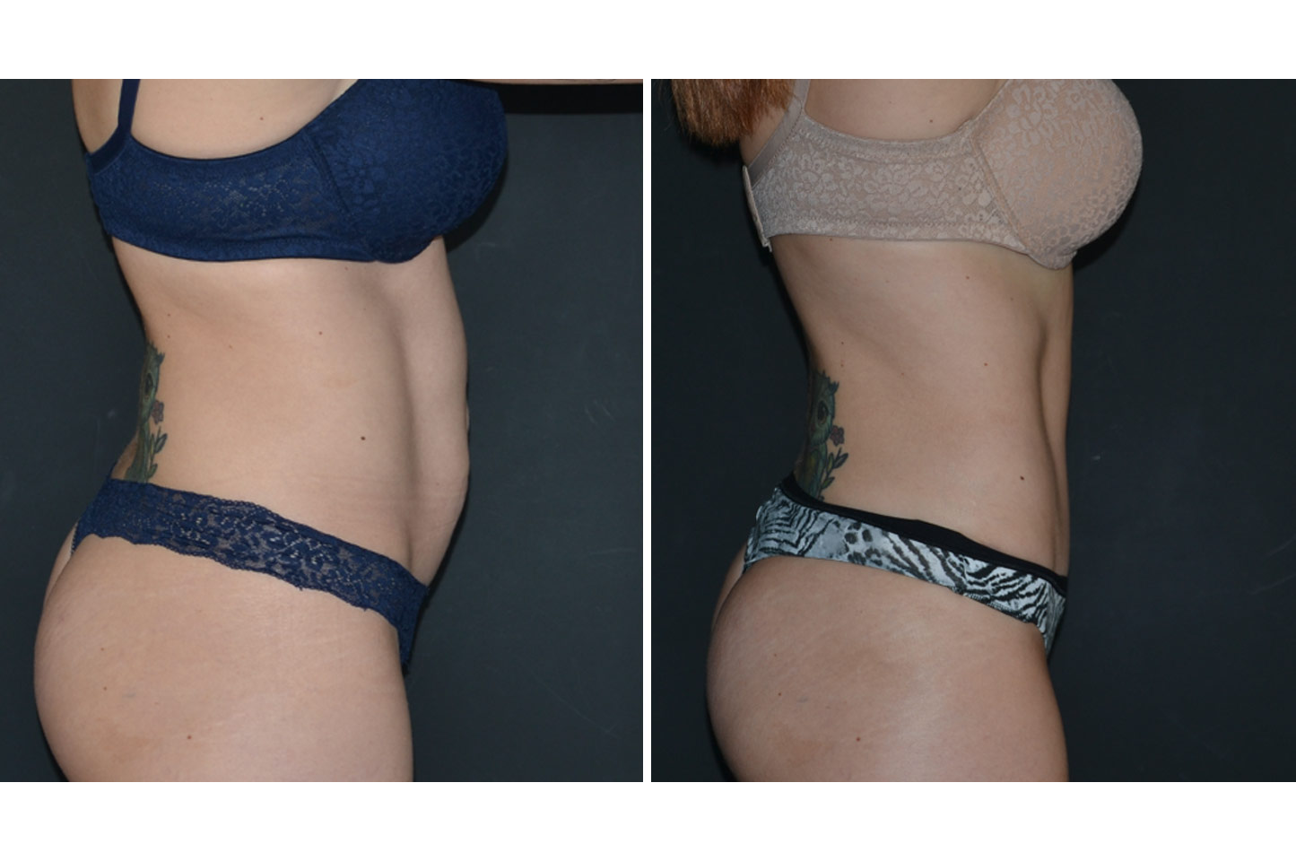 gallery-abdominoplasty-a3