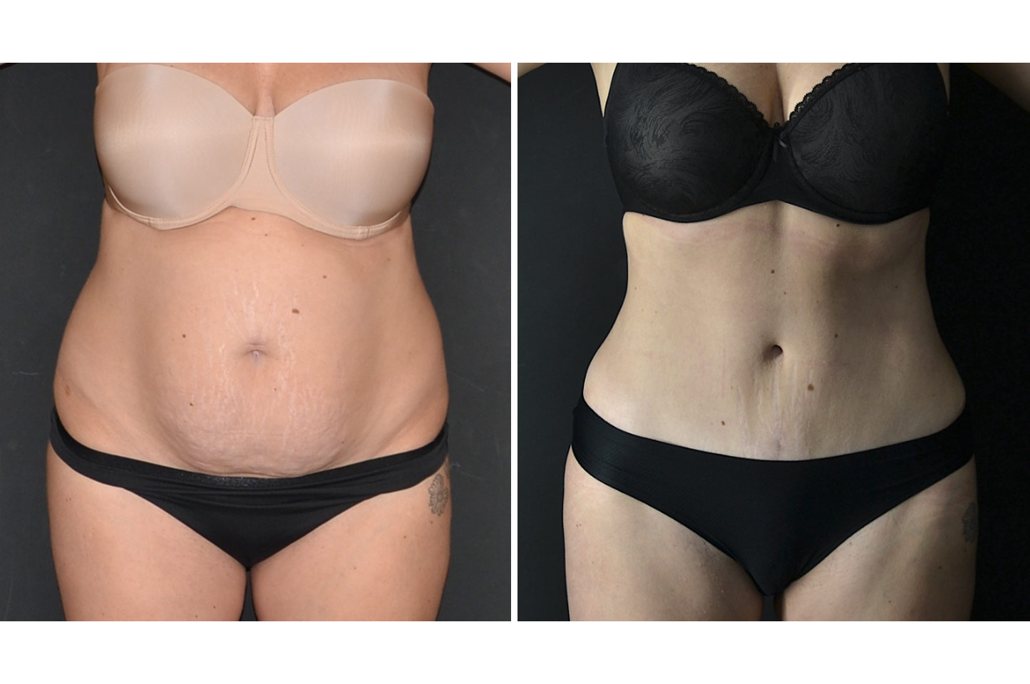 gallery-abdominoplasty-b1