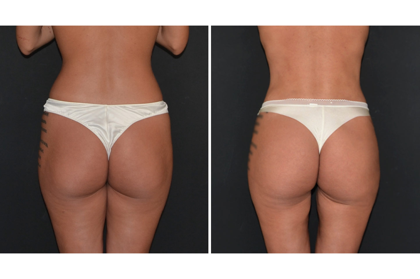Brazilian Butt Lift gallery-bbl-a1