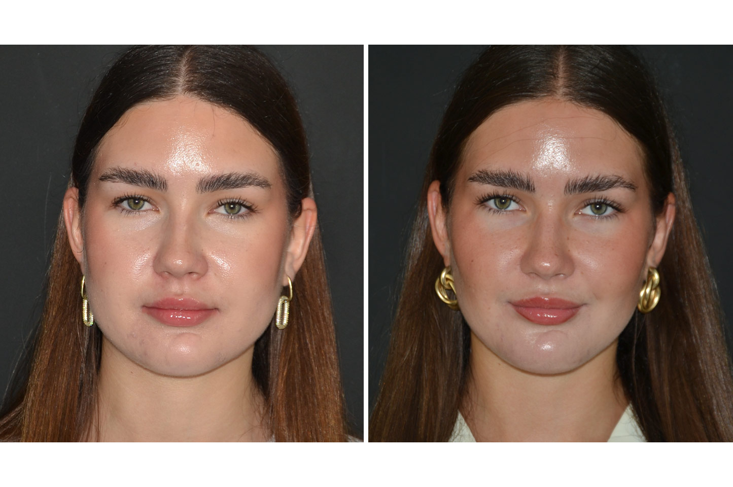 gallery-buccal-fat-reduction-a1