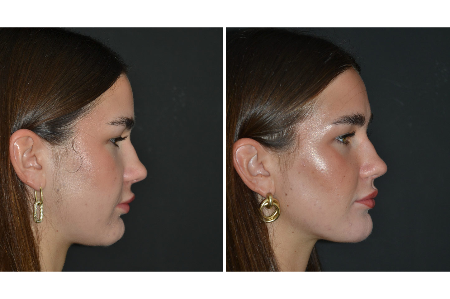 gallery-buccal-fat-reduction-a2