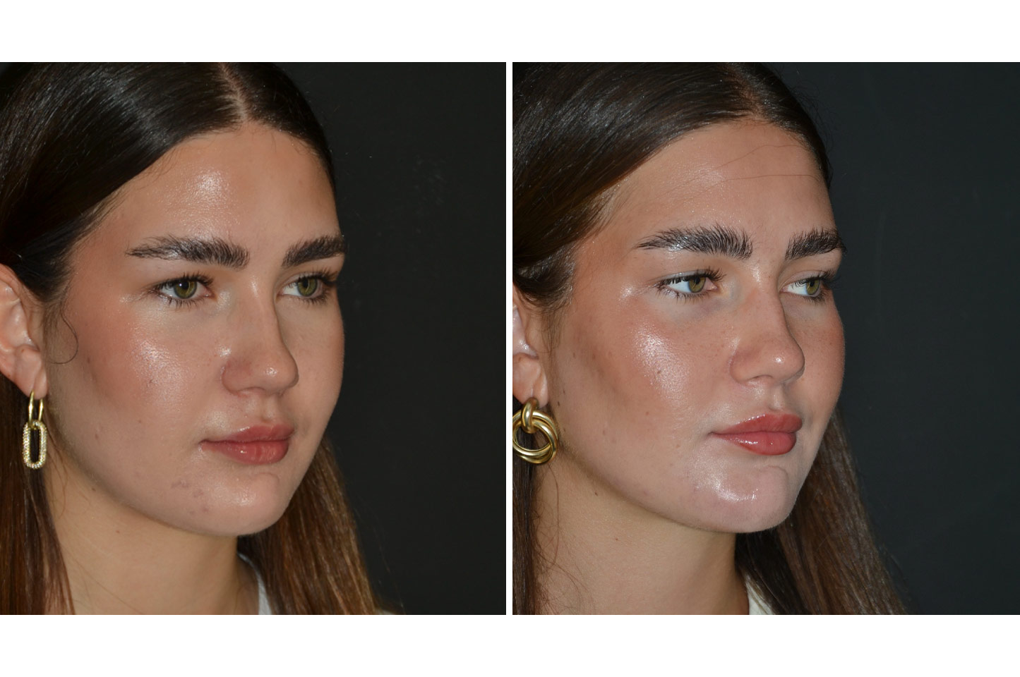 gallery-buccal-fat-reduction-a3