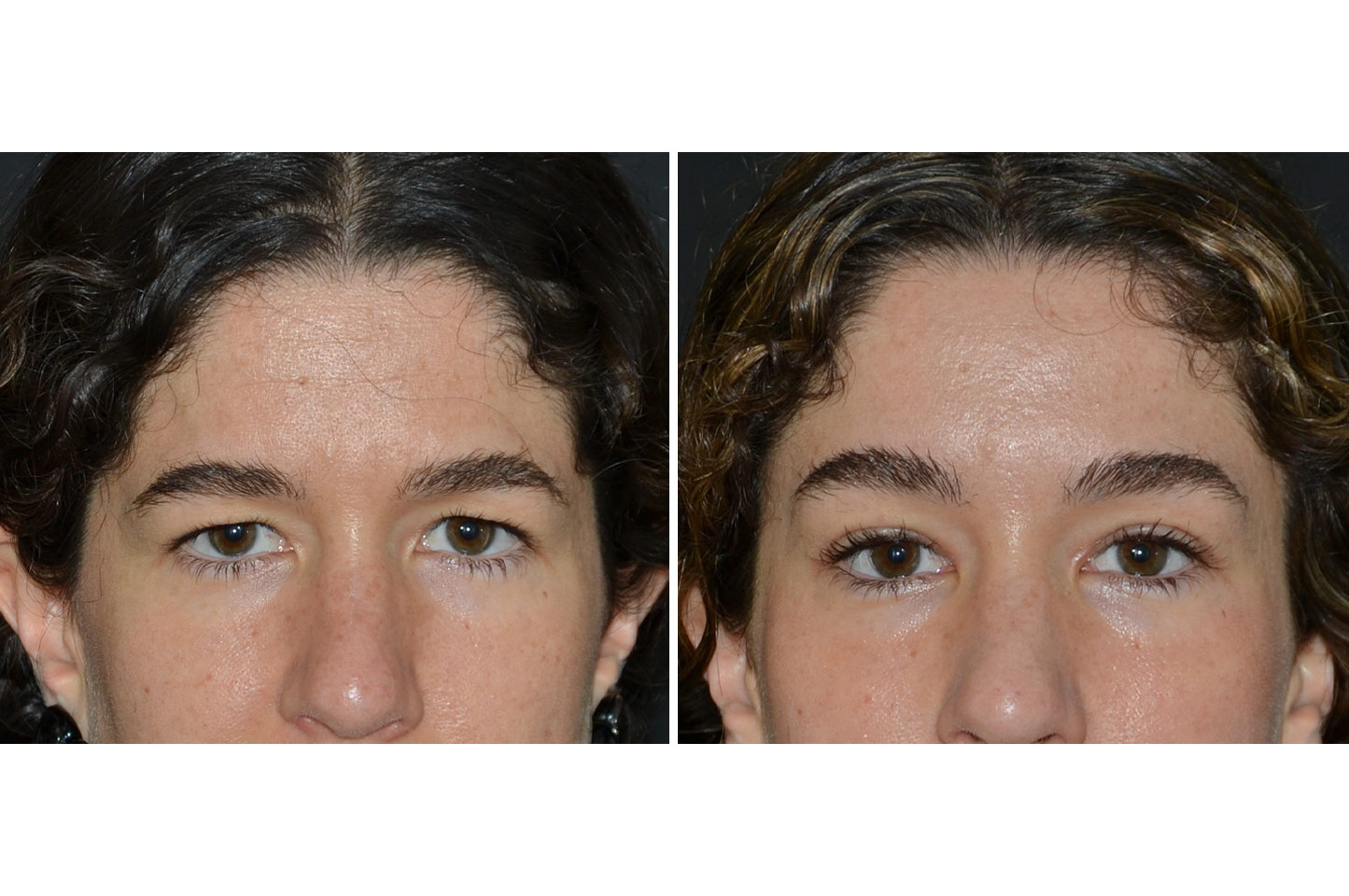 gallery-endoscopic-brow-lift-a1