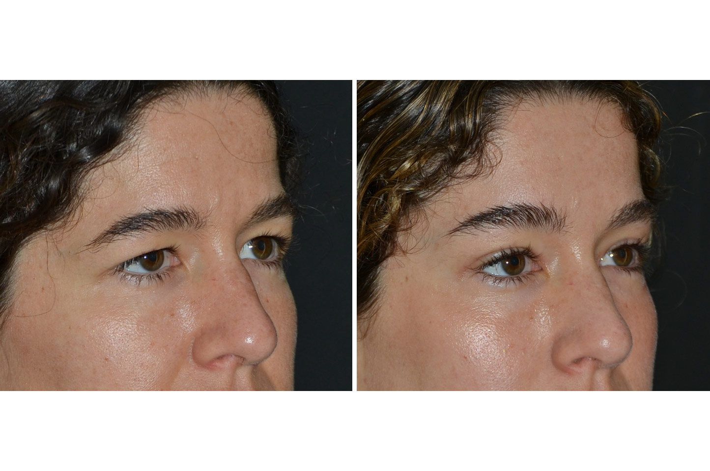 gallery-endoscopic-brow-lift-a2