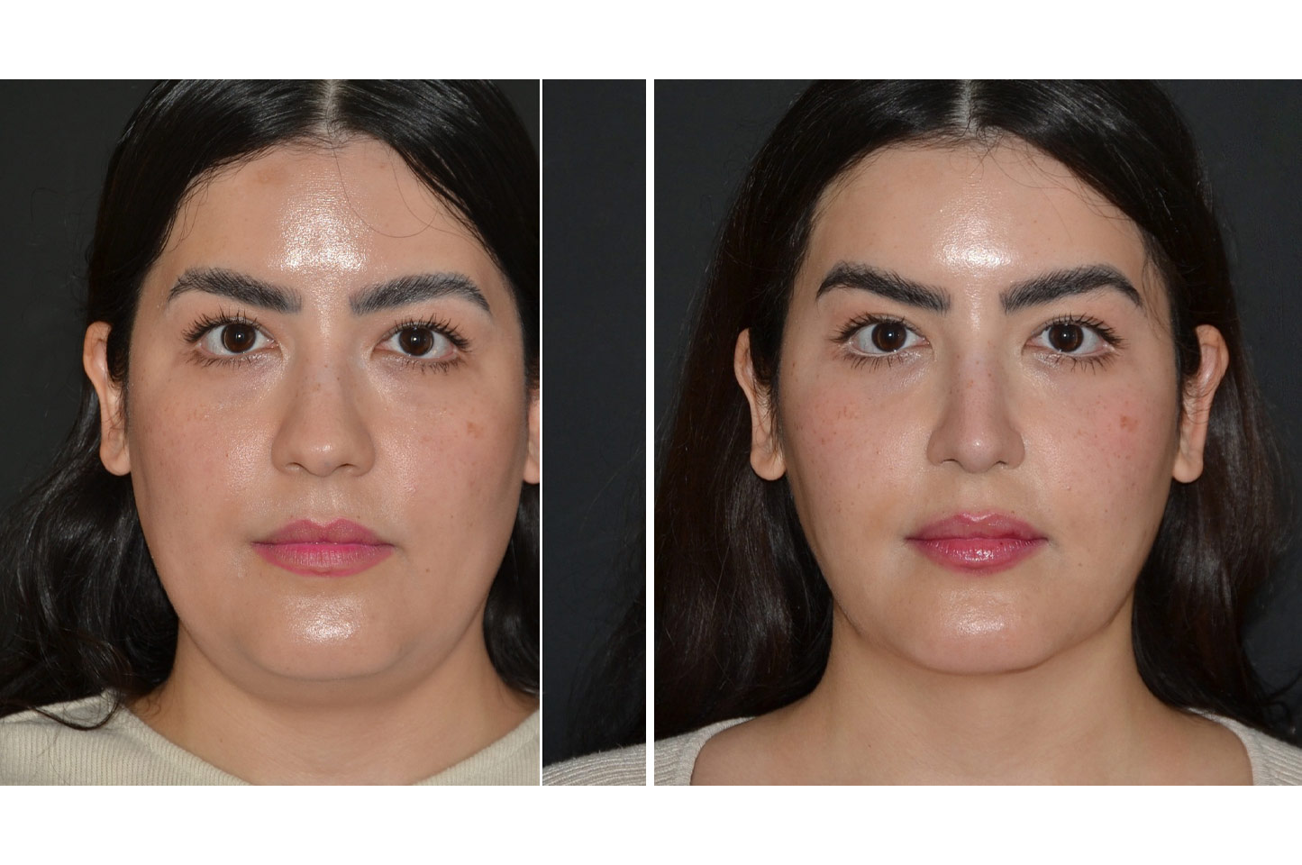 gallery-rhinoplasty-a1