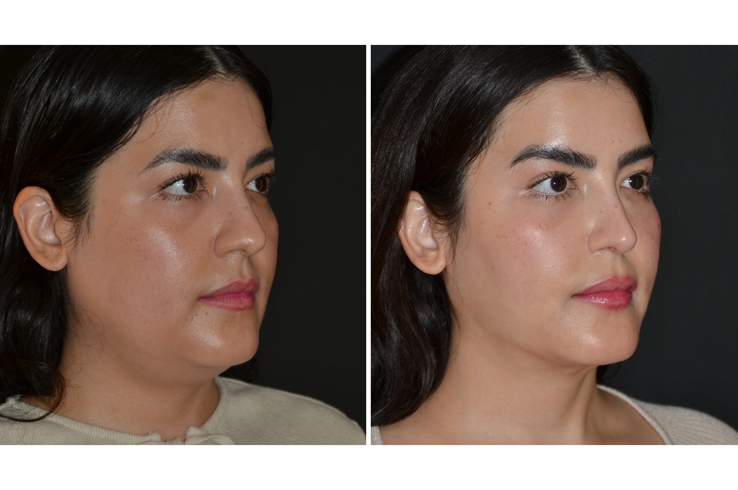 gallery-rhinoplasty-a2