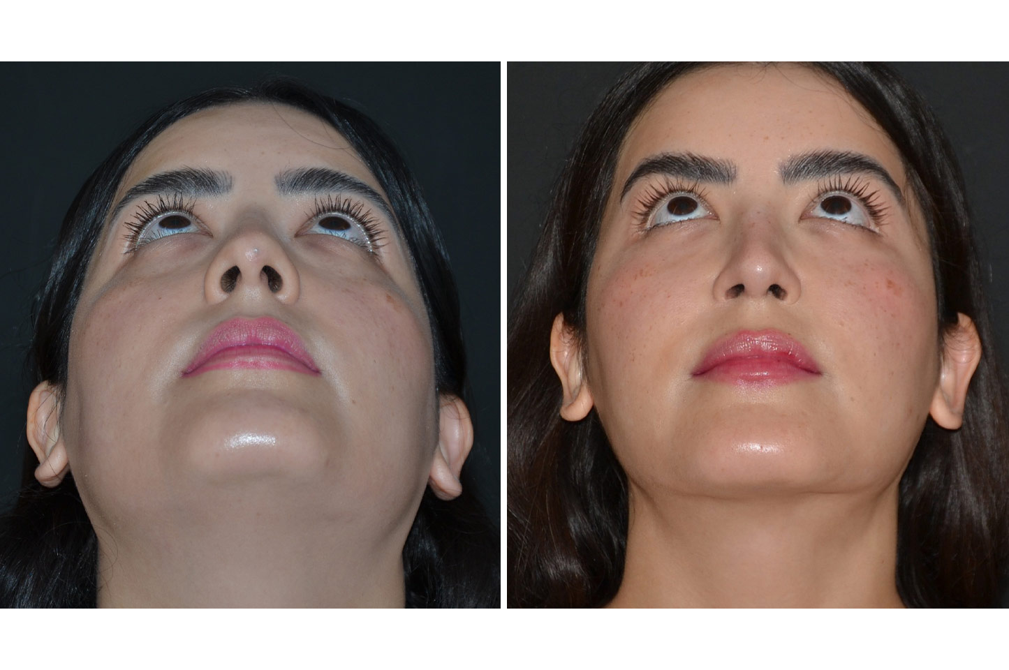 gallery-rhinoplasty-a3