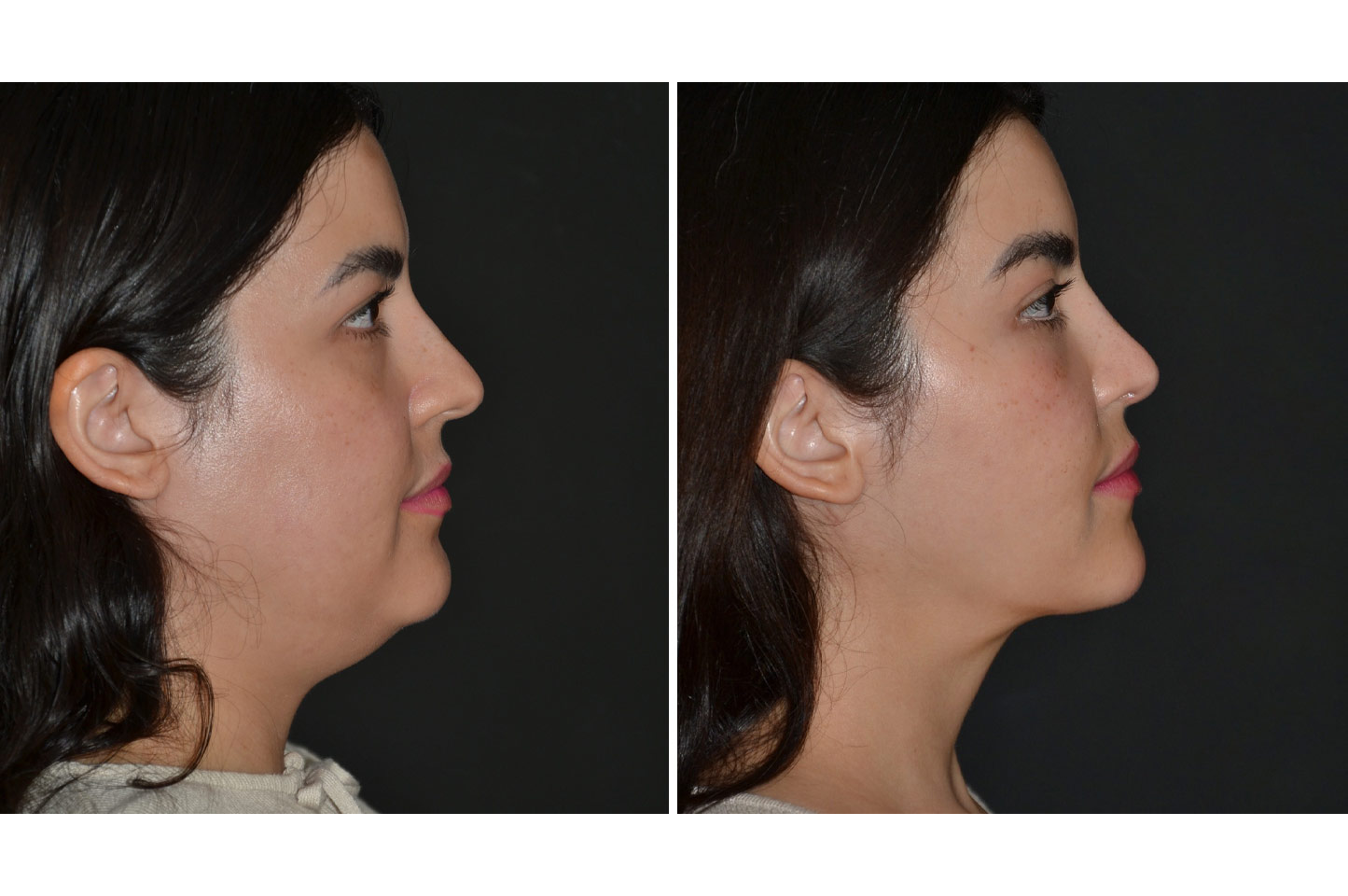 gallery-rhinoplasty-a4