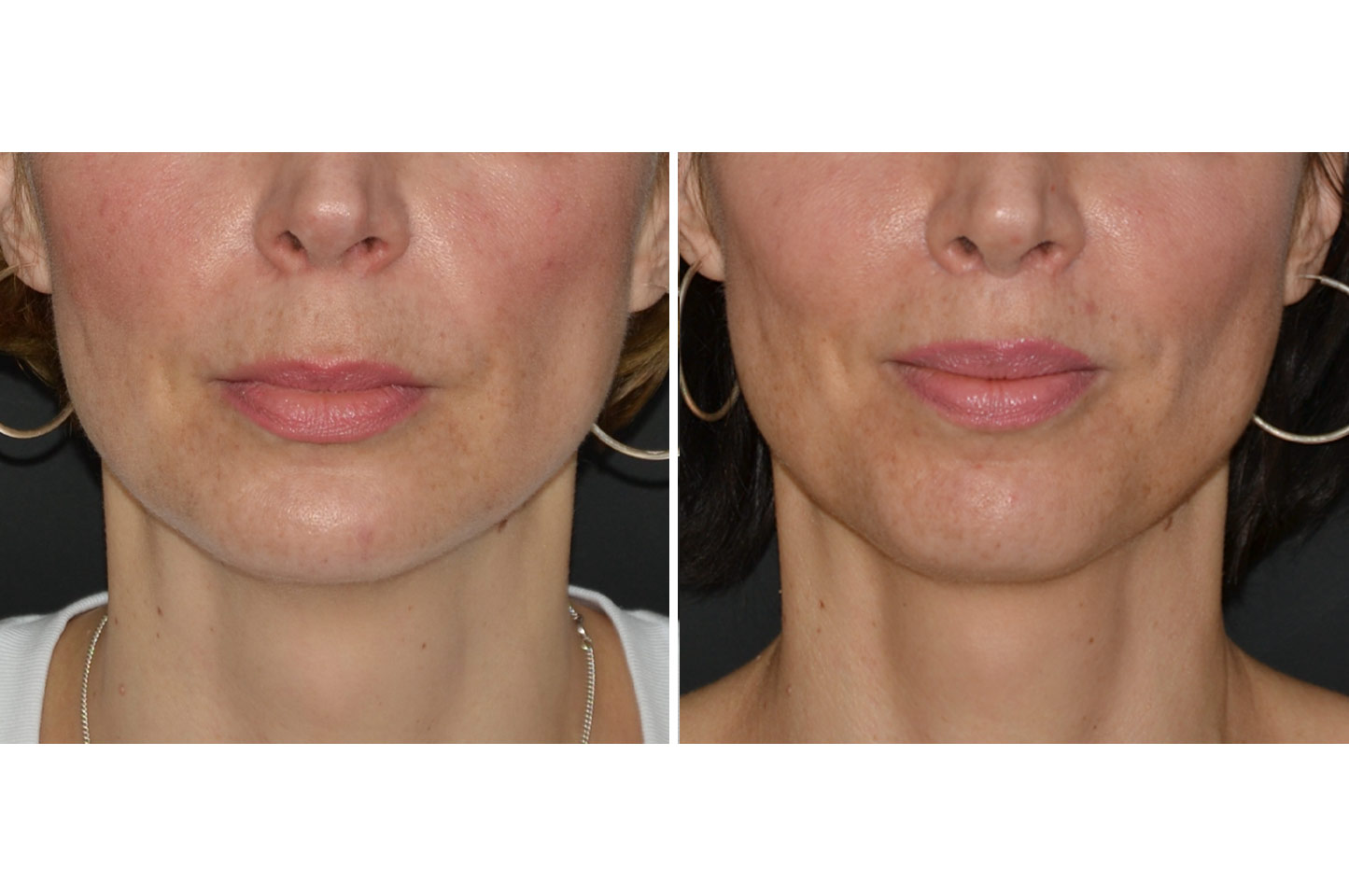 gallery-upper-lip-lift-a1