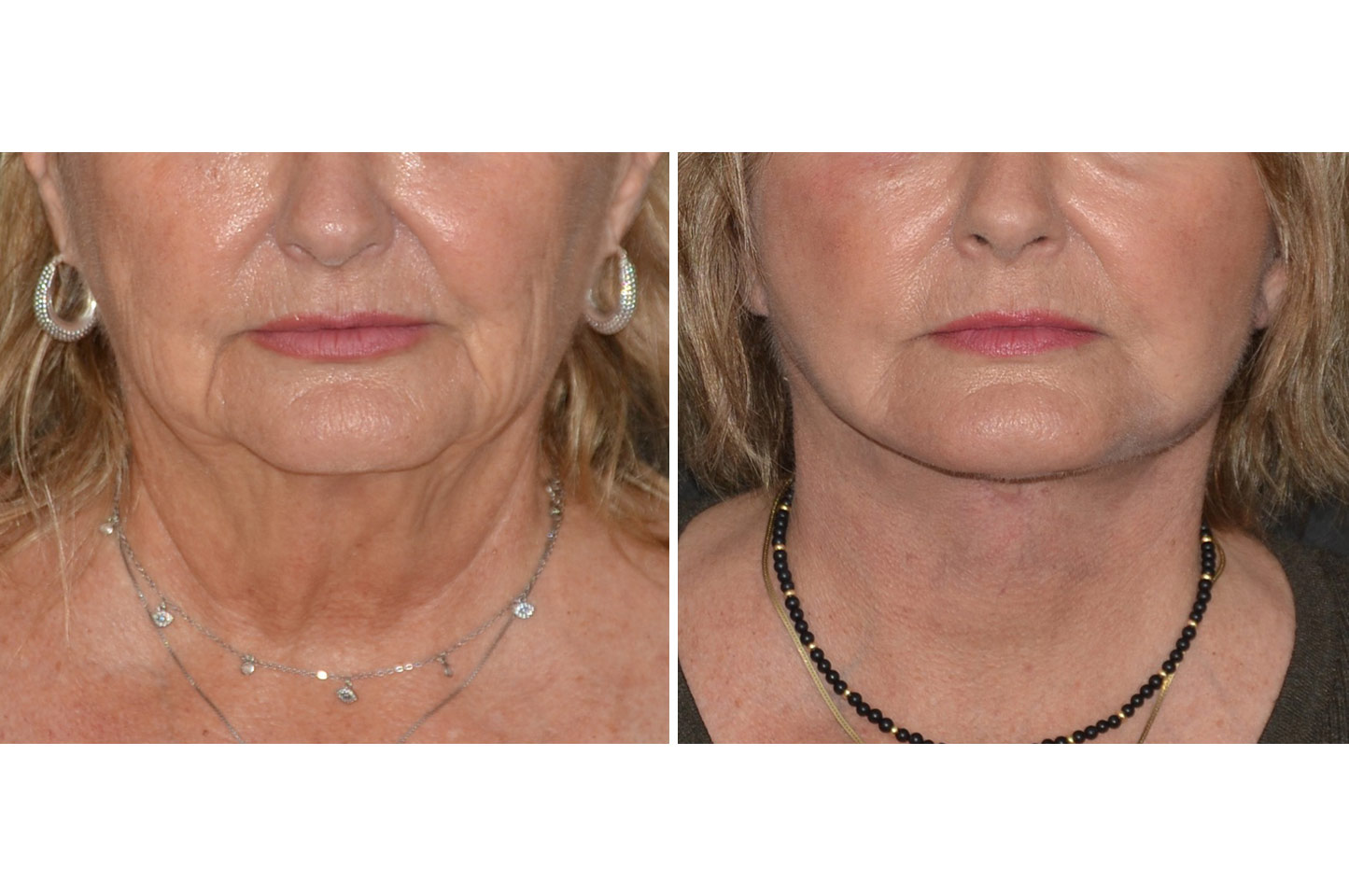 imagn-ba-neck-facelift-b1