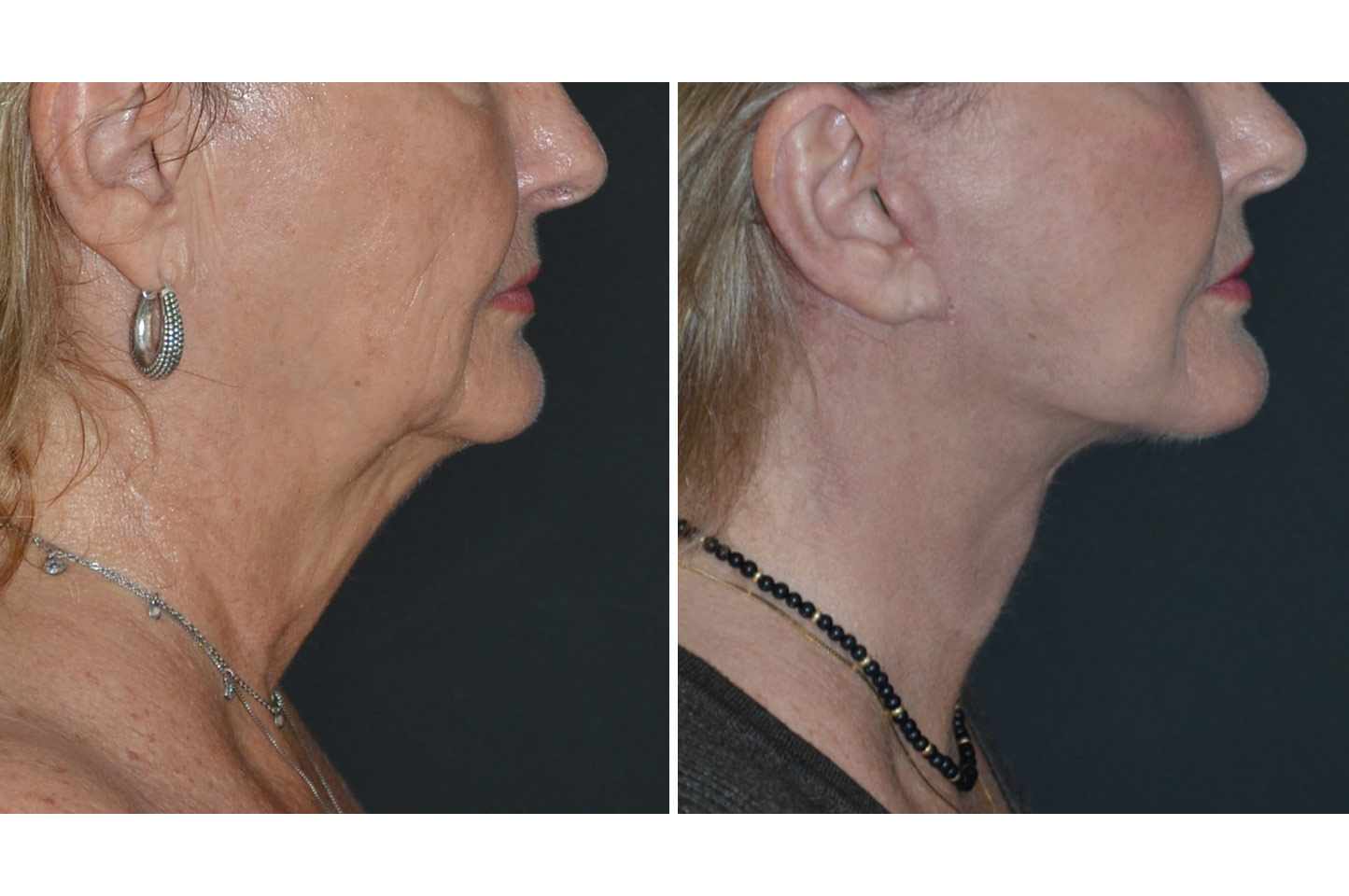 imagn-ba-neck-facelift-b2