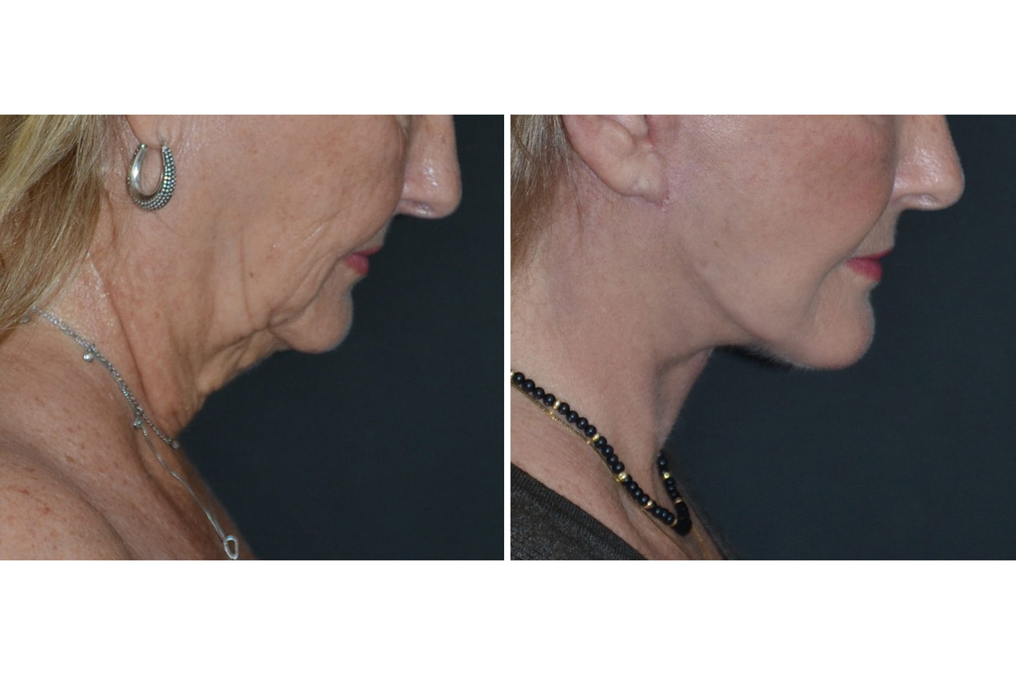 imagn-ba-neck-facelift-b3