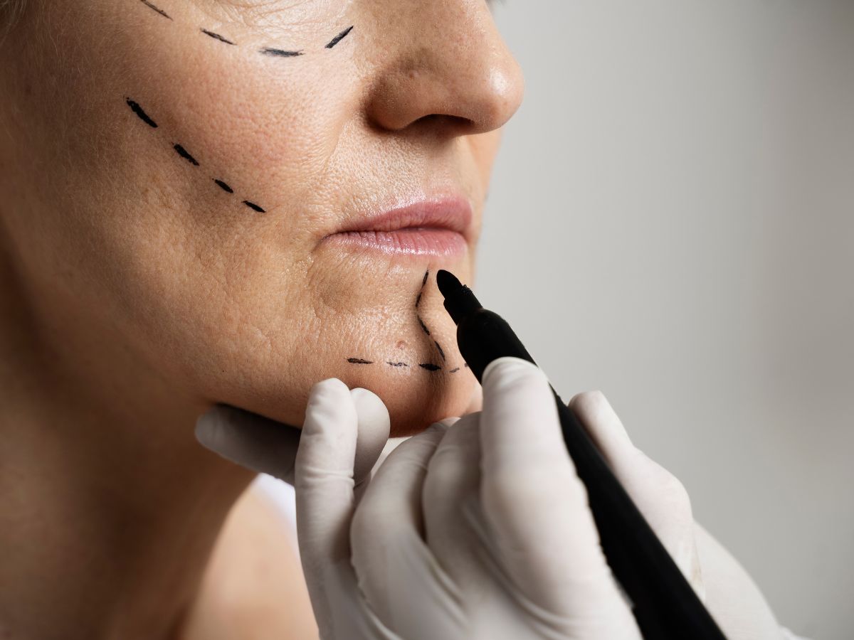Blog lifting facial mal hecho