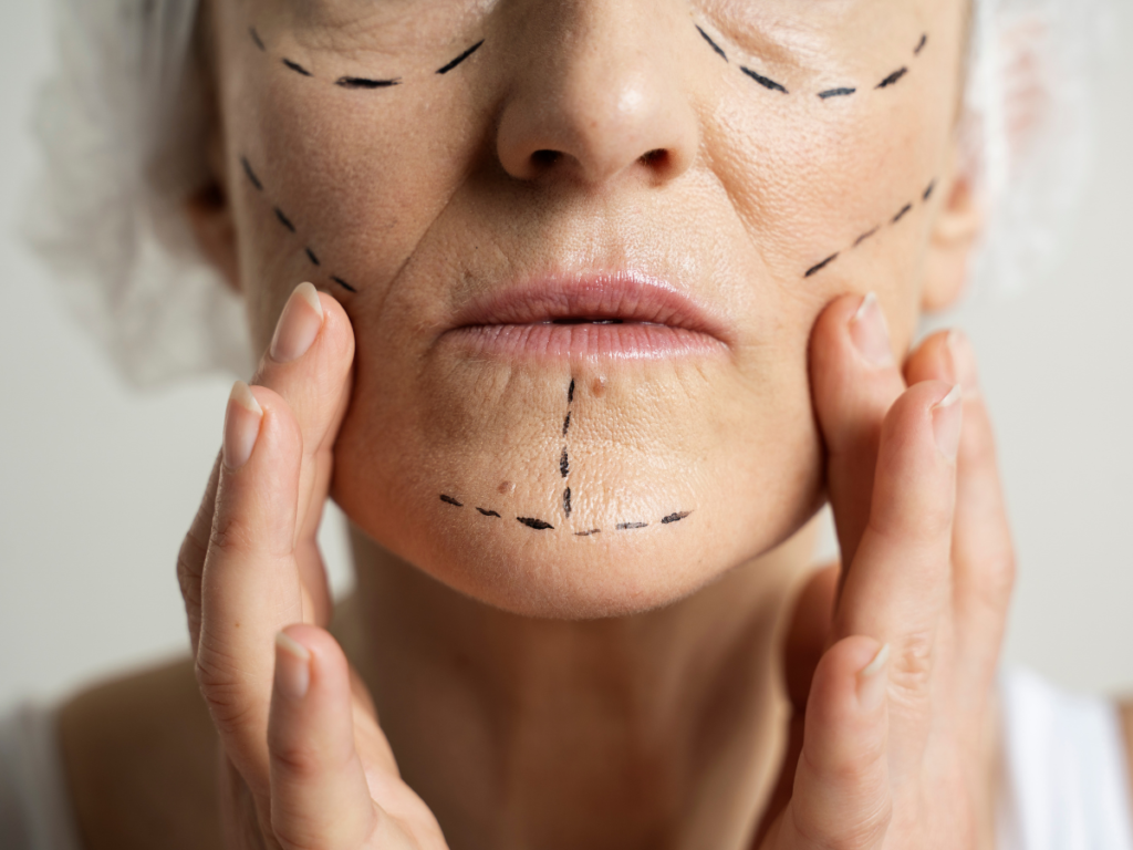 lifting facial mal hecho