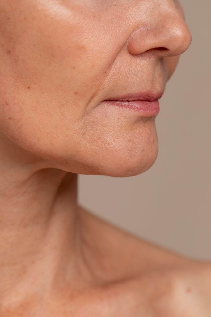 Lifting facial vs hilos tensores