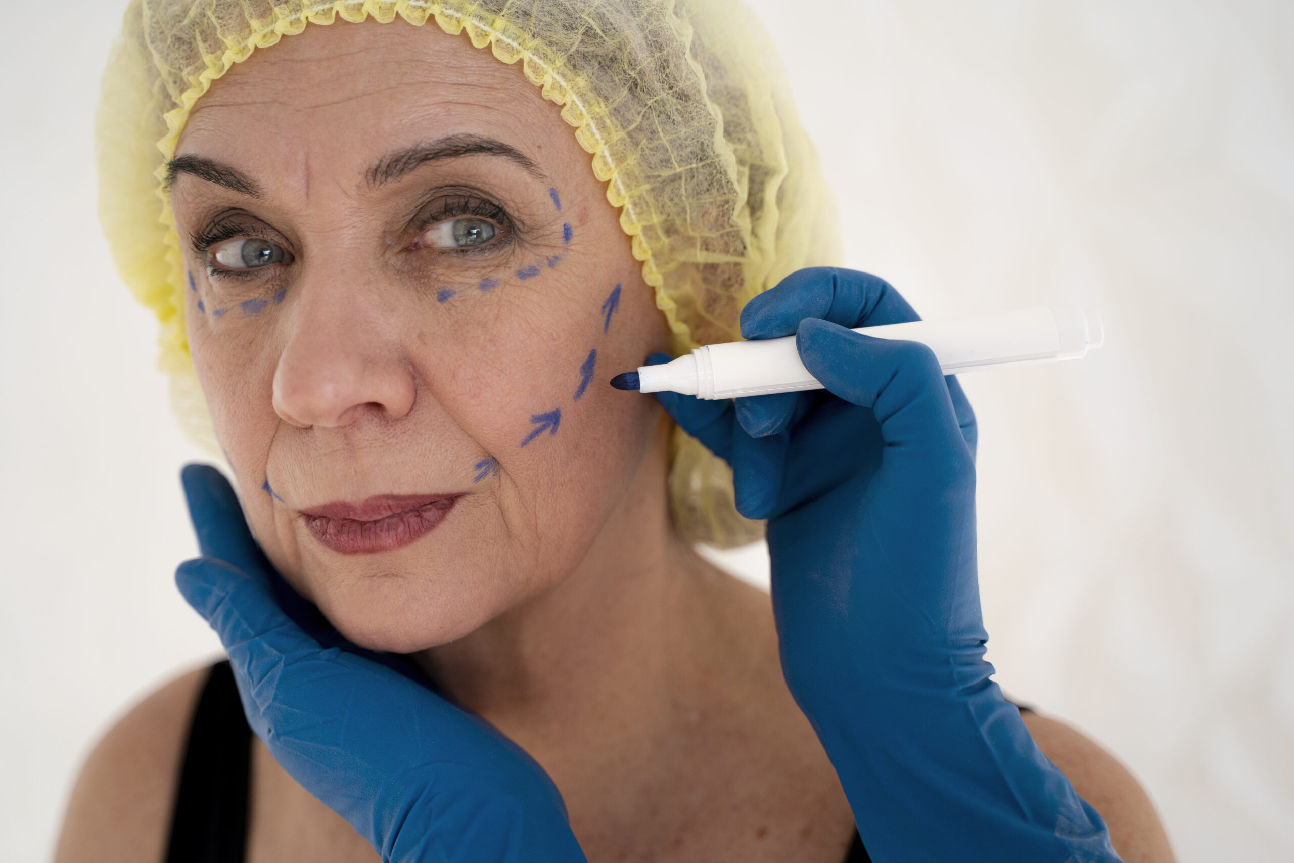 Blog diferencia entre Endolifting y Lifting Facial